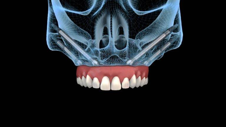 Dental Implant Video