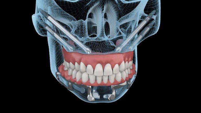 Teeth Implant Procedure Video