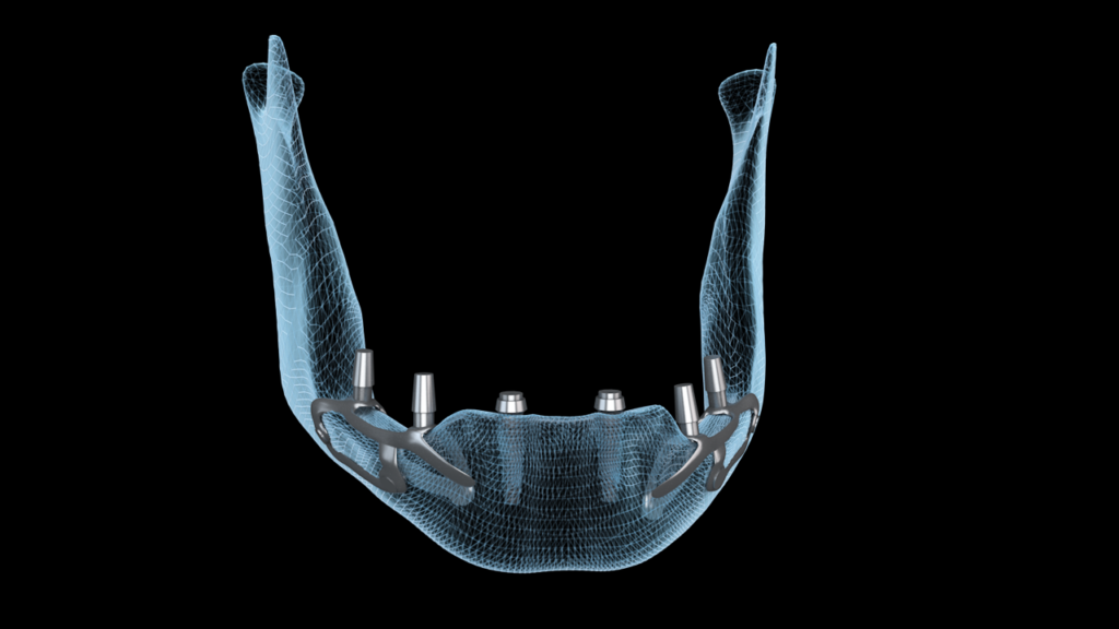 Dental implants are a transformative solution for individuals seeking to restore their smiles and improve oral health. However, the process of dental implant placement can seem complex and intimidating to patients. This is where 3D animation emerges as a game-changing tool, offering a clear, engaging, and highly visual explanation of the procedure. In this article, we explore the power of 3D animation in explaining dental implant procedures and why it is the best tool for visualizing these complex processes.