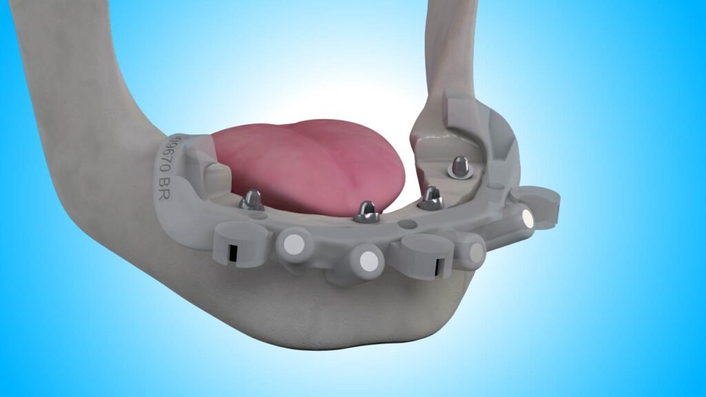 3D dental illustration of a lower jaw with a surgical guide and four dental implants placed for an All-on-4 implant procedure.
