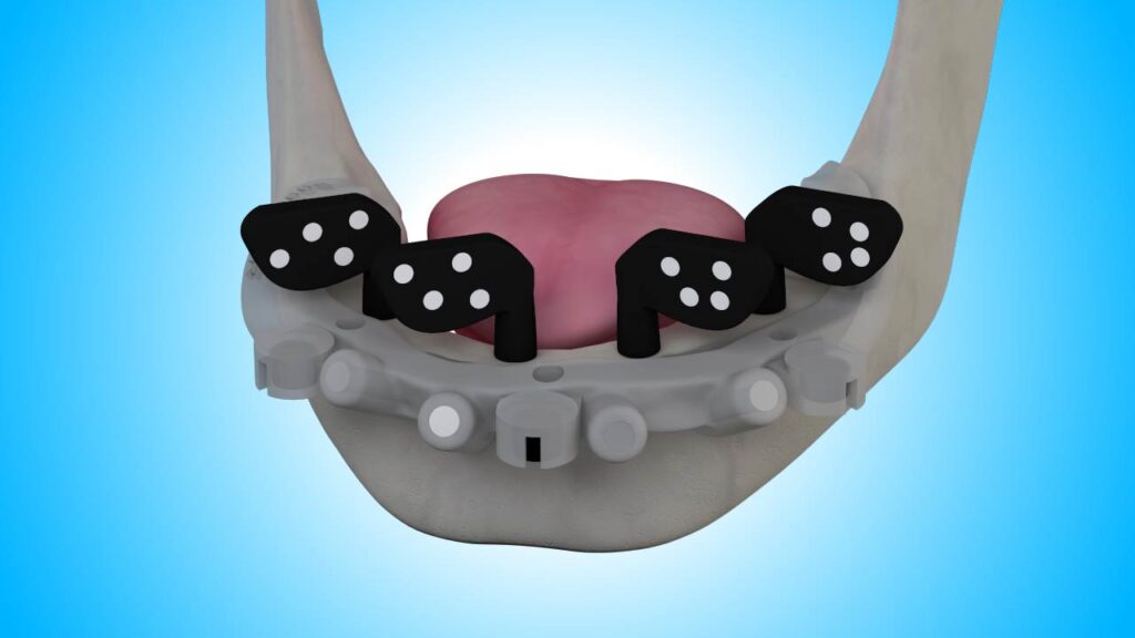 3D dental illustration showing a lower jaw with a surgical guide and four black implant markers positioned for an All-on-4 dental implant procedure.