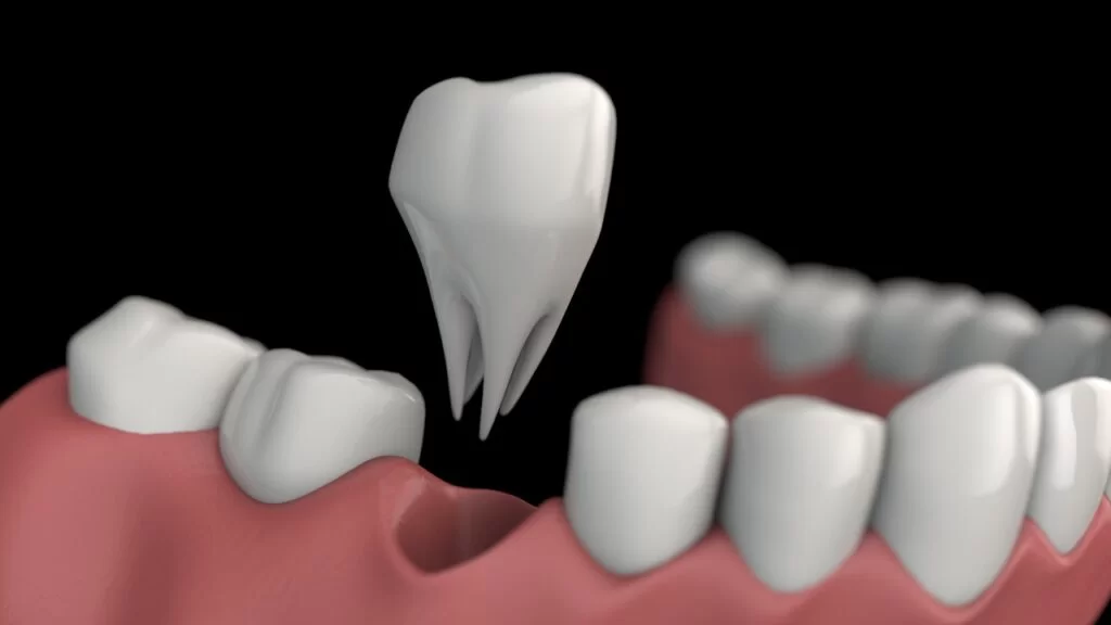 3D dental procedure video visualization showing implant, root canal, and crown treatment examples
