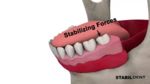3D cross-section of a tooth showing a root canal procedure with infected pulp being removed