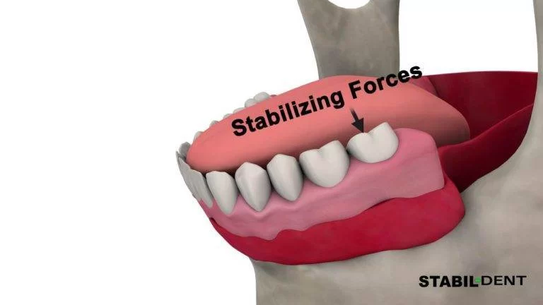 3D cross-section of a tooth showing a root canal procedure with infected pulp being removed